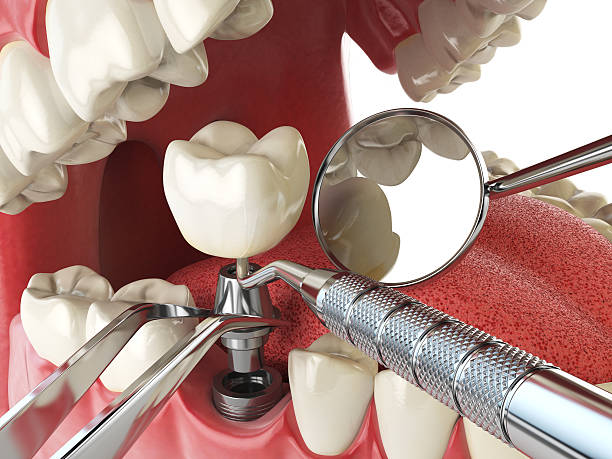Best Emergency Tooth Extraction in Jupiter, FL